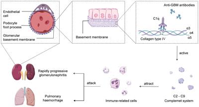 Unleashing the power of complement activation: unraveling renal damage in human anti-glomerular basement membrane disease